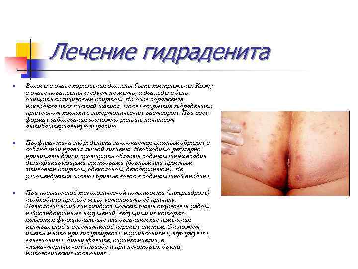 Лечение гидраденита n n n Волосы в очаге поражения должны быть пострижены. Кожу в