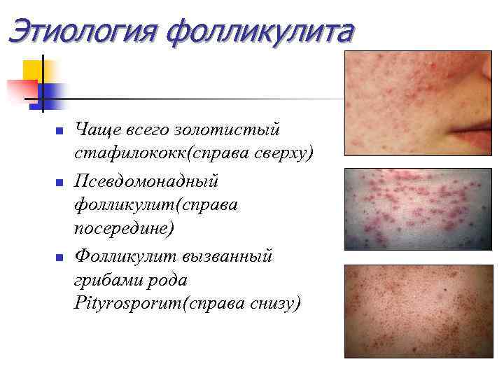 Этиология фолликулита n n n Чаще всего золотистый стафилококк(справа сверху) Псевдомонадный фолликулит(справа посередине) Фолликулит