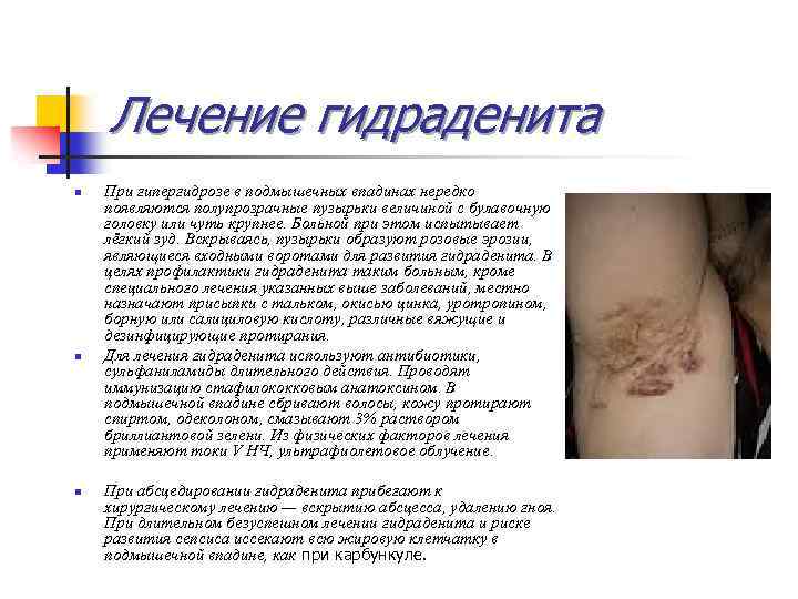 Лечение гидраденита n n n При гипергидрозе в подмышечных впадинах нередко появляются полупрозрачные пузырьки