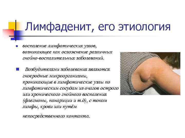Лимфаденит, его этиология n n воспаление лимфатических узлов, возникающее как осложнение различных гнойно-воспалительных заболеваний.