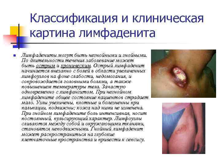 Классификация и клиническая картина лимфаденита n Лимфадениты могут быть негнойными и гнойными. По длительности