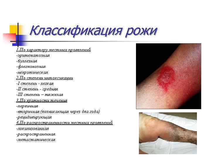 Классификация рожи 1. По характеру местных проявлений -эритематозная -буллезная -флегмонозная -некротическая 2. По степени