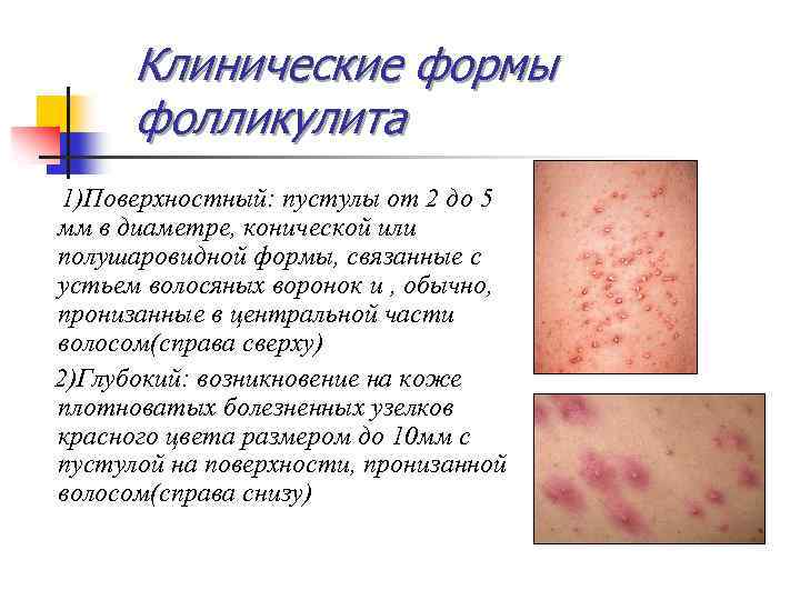 Клинические формы фолликулита 1)Поверхностный: пустулы от 2 до 5 мм в диаметре, конической или