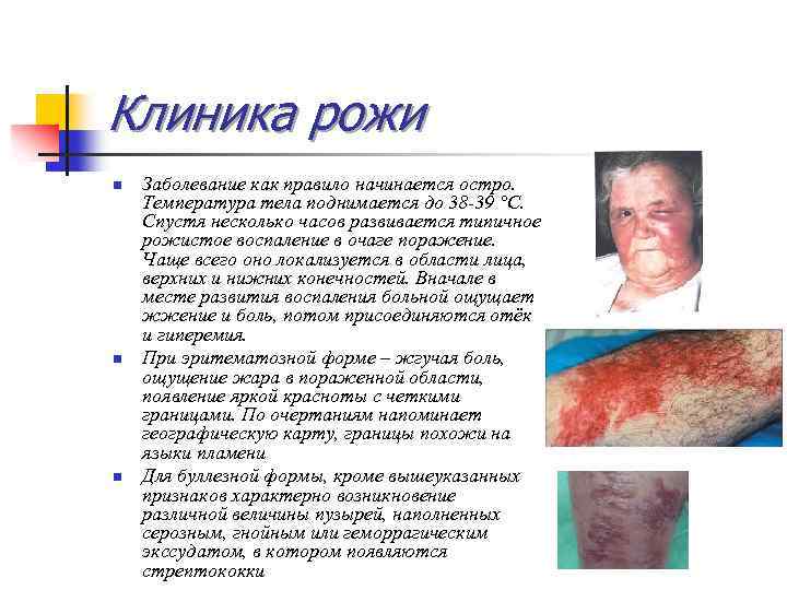 Клиника рожи n n n Заболевание как правило начинается остро. Температура тела поднимается до