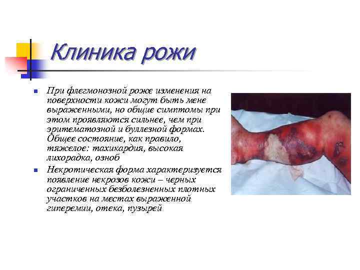 Клиника рожи n n При флегмонозной роже изменения на поверхности кожи могут быть мене