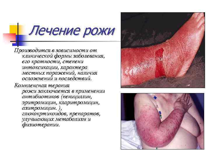 Лечение рожи Производится в зависимости от клинической формы заболевания, его кратности, степени интоксикации, характера