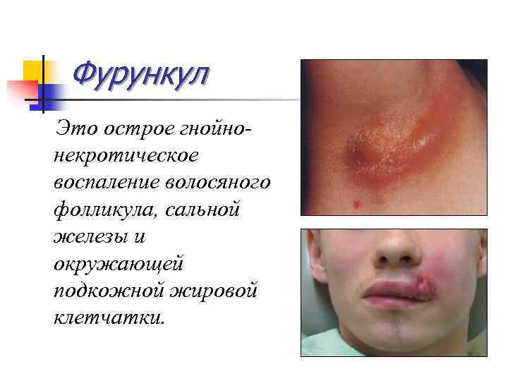 Фурункул Это острое гнойнонекротическое воспаление волосяного фолликула, сальной железы и окружающей подкожной жировой клетчатки.