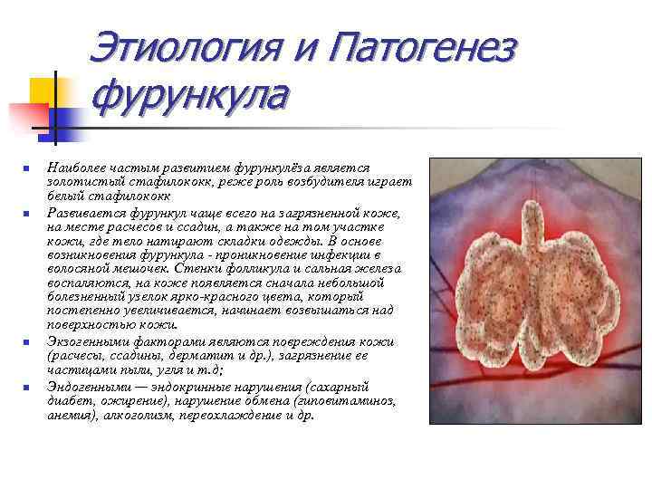Этиология и Патогенез фурункула n n Наиболее частым развитием фурункулёза является золотистый стафилококк, реже