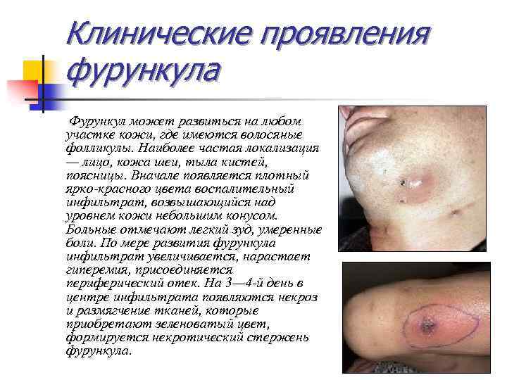 Клинические проявления фурункула Фурункул может развиться на любом участке кожи, где имеются волосяные фолликулы.