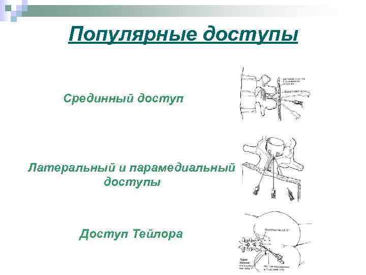 Популярные доступы Срединный доступ Латеральный и парамедиальный доступы Доступ Тейлора 