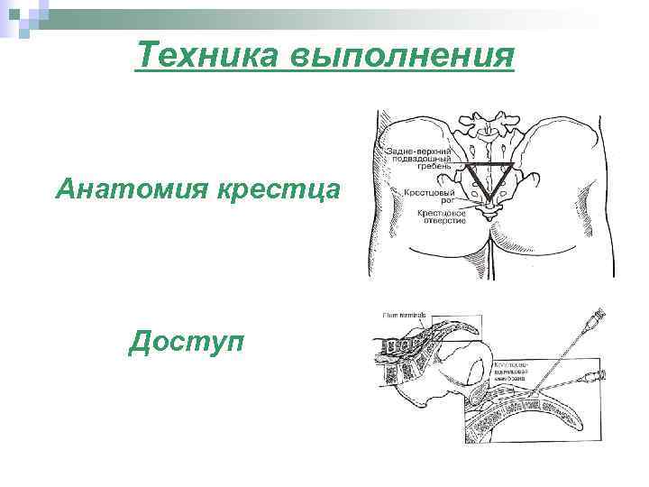 Техника выполнения Анатомия крестца Доступ 