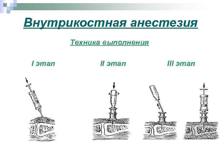 Внутрикостная анестезия Техника выполнения I этап III этап 