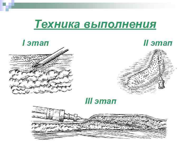 Техника выполнения I этап III этап 