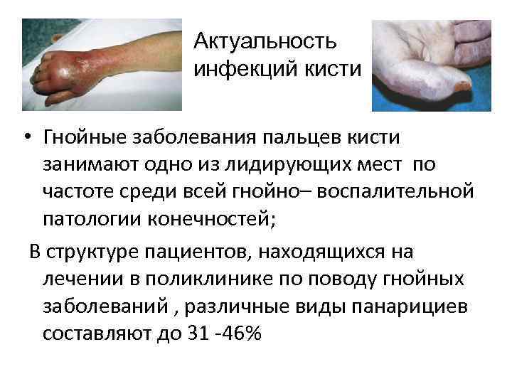 Актуальность инфекций кисти • Гнойные заболевания пальцев кисти занимают одно из лидирующих мест по