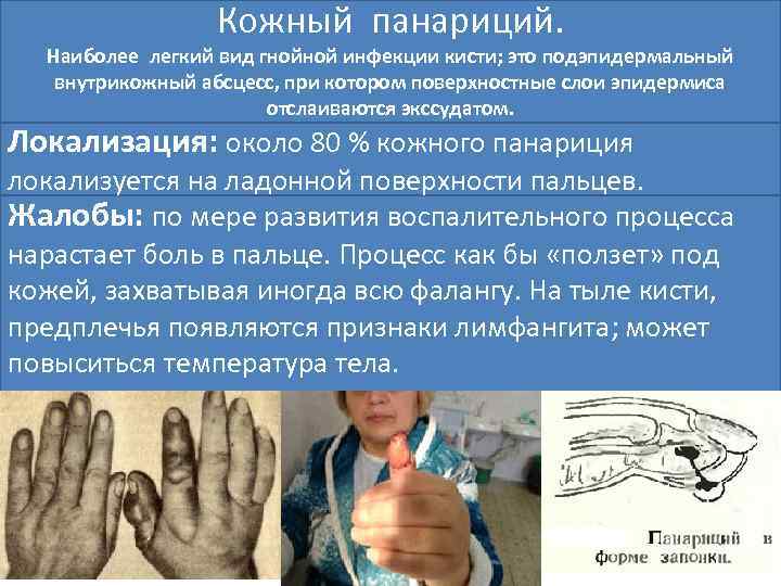 Кожный панариций. Наиболее легкий вид гнойной инфекции кисти; это подэпидермальный внутрикожный абсцесс, при котором