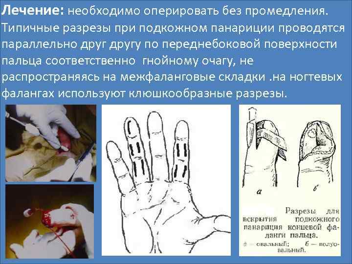 Лечение: необходимо оперировать без промедления. Типичные разрезы при подкожном панариции проводятся параллельно другу по