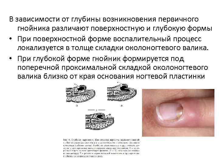 В зависимости от глубины возникновения первичного гнойника различают поверхностную и глубокую формы • При