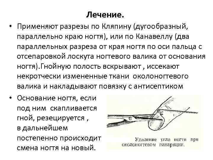 Лечение. • Применяют разрезы по Кляпину (дугообразный, параллельно краю ногтя), или по Канавеллу (два