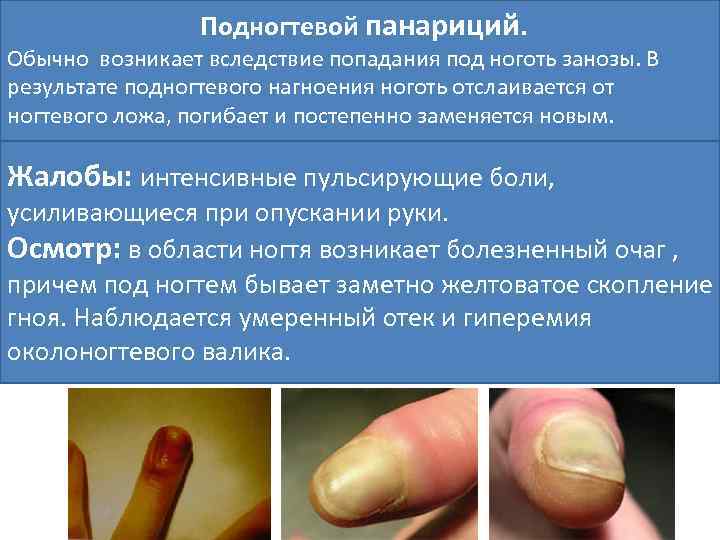 Подногтевой панариций. Обычно возникает вследствие попадания под ноготь занозы. В результате подногтевого нагноения ноготь
