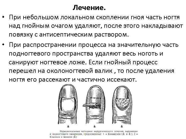 Лечение. • При небольшом локальном скоплении гноя часть ногтя над гнойным очагом удаляют, после