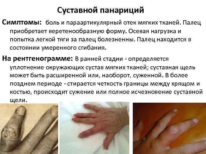 Суставной панариций Симптомы: боль и параартикулярный отек мягких тканей. Палец приобретает веретенообразную форму. Осевая