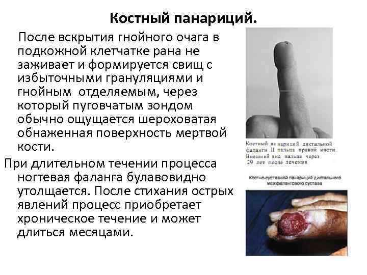 Костный панариций. После вскрытия гнойного очага в подкожной клетчатке рана не заживает и формируется