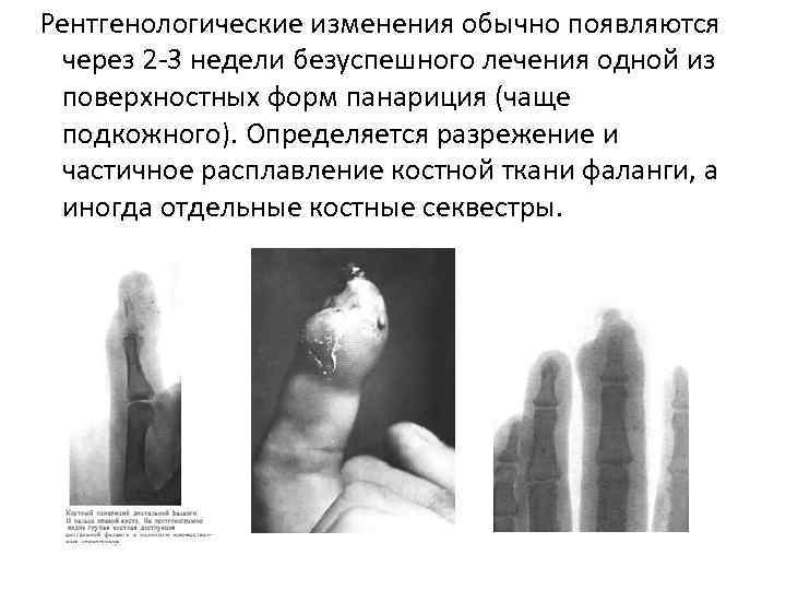  Рентгенологические изменения обычно появляются через 2 -3 недели безуспешного лечения одной из поверхностных
