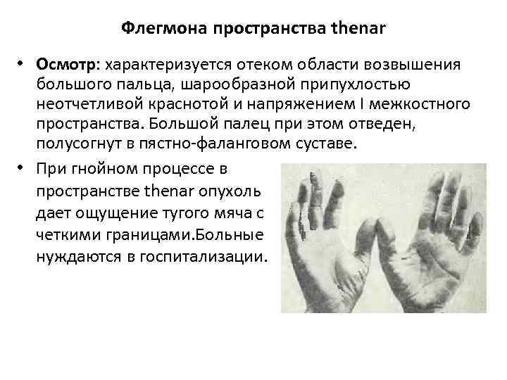 Флегмона пространства thenar • Осмотр: характеризуется отеком области возвышения большого пальца, шарообразной припухлостью неотчетливой