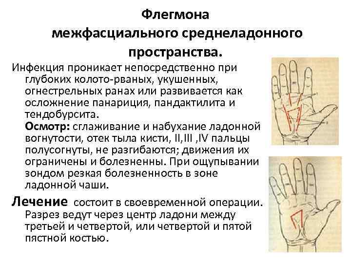 Флегмона межфасциального среднеладонного пространства. Инфекция проникает непосредственно при глубоких колото-рваных, укушенных, огнестрельных ранах или