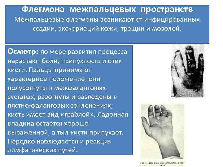 Флегмона межпальцевых пространств Межпальцевые флегмоны возникают от инфицированных ссадин, экскориаций кожи, трещин и мозолей.