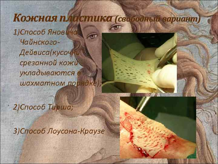 Кожная пластика (свободный вариант) 1)Способ Яновича. Чайнского. Дейвиса(кусочки срезанной кожи укладываются в шахматном порядке);