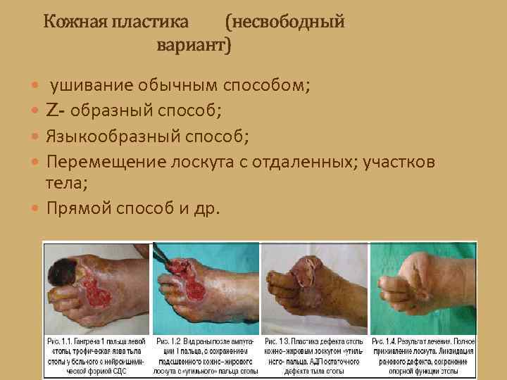 Кожная пластика (несвободный вариант) ушивание обычным способом; Z- образный способ; Языкообразный способ; Перемещение лоскута