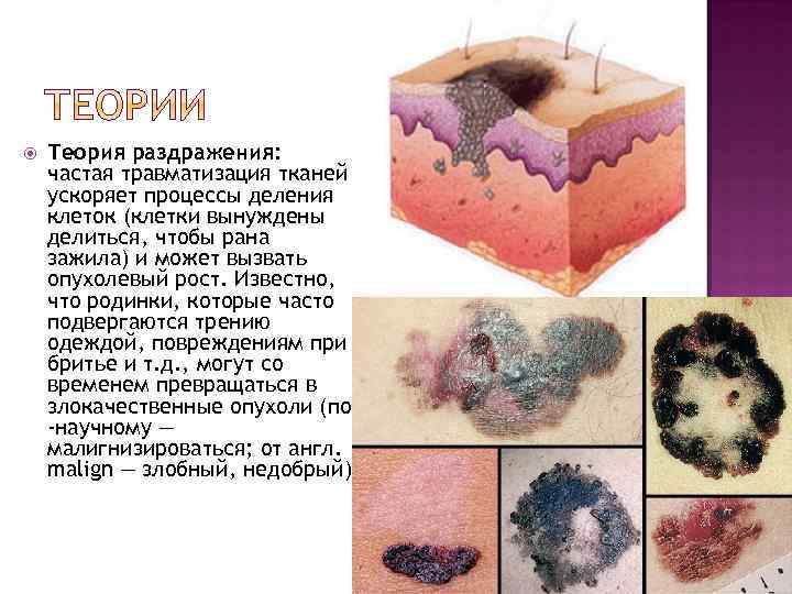  Теория раздражения: частая травматизация тканей ускоряет процессы деления клеток (клетки вынуждены делиться, чтобы