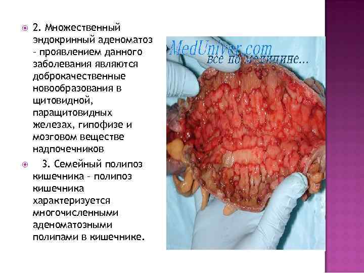  2. Множественный эндокринный аденоматоз – проявлением данного заболевания являются доброкачественные новообразования в щитовидной,