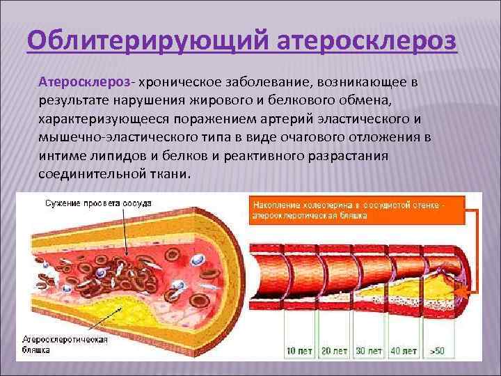 Облитерирующий атеросклероз картинки