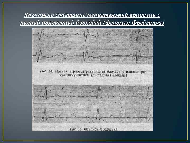 Возможно сочетание мерцательной аритмии с полной поперечной блокадой (феномен Фредерика) 