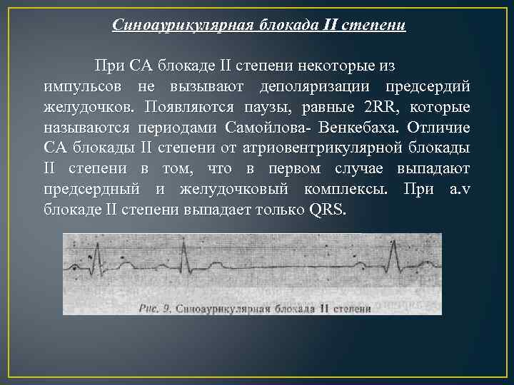 Са блокада 2 степени. Синоаурикулярная блокада без периодов Самойлова-Венкебаха. Синоатриальная блокада 2 степени с периодами Самойлова Венкебаха. Синоаурикулярной блокады II степени. Са-блокада II степени Мобитц 2.