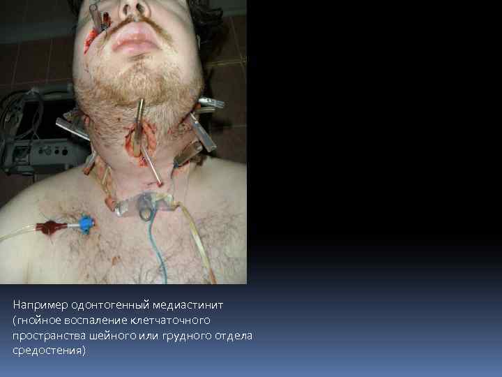 Например одонтогенный медиастинит (гнойное воспаление клетчаточного пространства шейного или грудного отдела средостения) 