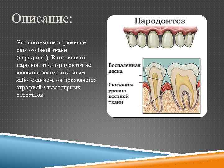 Рентгенологическая картина костной ткани челюстей при пародонтите тяжелой степени