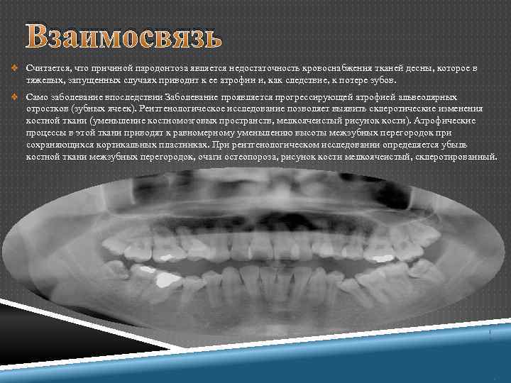 Взаимосвязь v Считается, что причиной пародонтоза является недостаточность кровоснабжения тканей десны, которое в тяжелых,