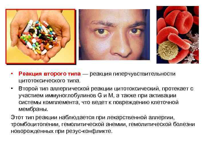  • Реакция второго типа — реакция гиперчувствительности цитотоксического типа. • Второй тип аллергической