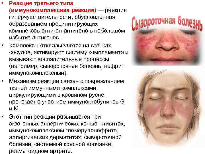  • Реакция третьего типа (иммунокомплексная реакция) — реакция гиперчувствительности, обусловленная образованием преципитирующих комплексов