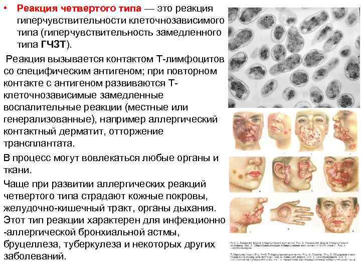 • Реакция четвертого типа — это реакция гиперчувствительности клеточнозависимого типа (гиперчувствительность замедленного типа