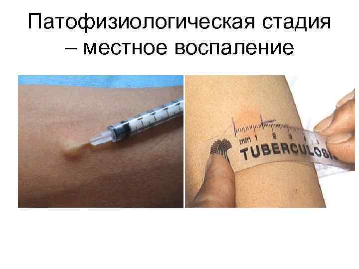 Патофизиологическая стадия – местное воспаление 