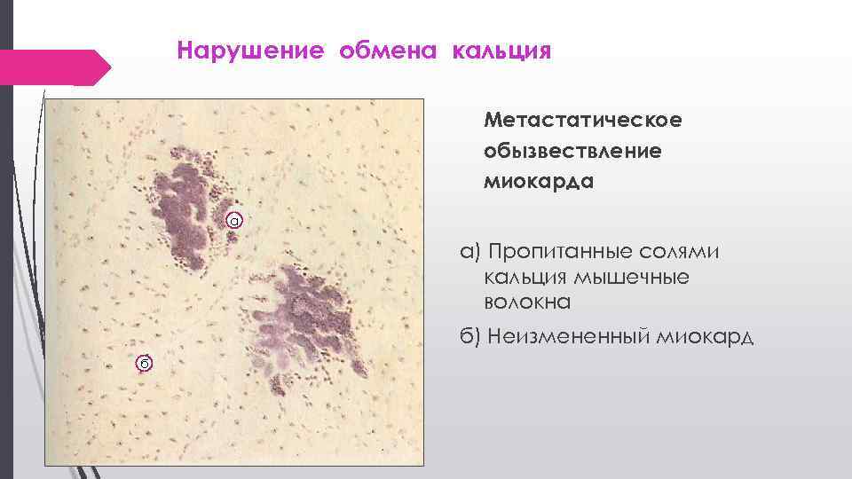 Нарушение обмена кальция Метастатическое обызвествление миокарда а а) Пропитанные солями кальция мышечные волокна б)