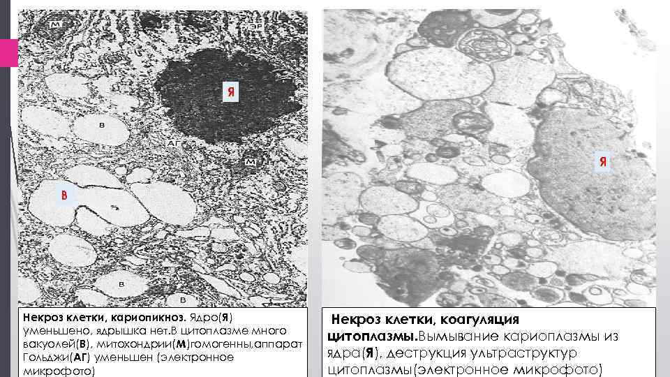 Я Я В Некроз клетки, кариопикноз. Ядро(Я) уменьшено, ядрышка нет. В цитоплазме много вакуолей(В),