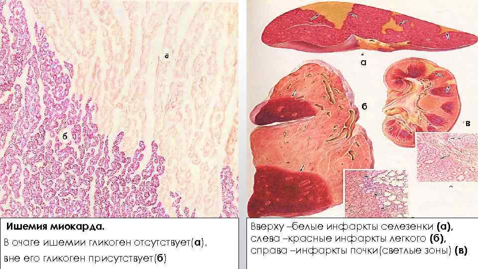 а б в Ишемия миокарда. В очаге ишемии гликоген отсутствует(а), вне его гликоген присутствует(б)