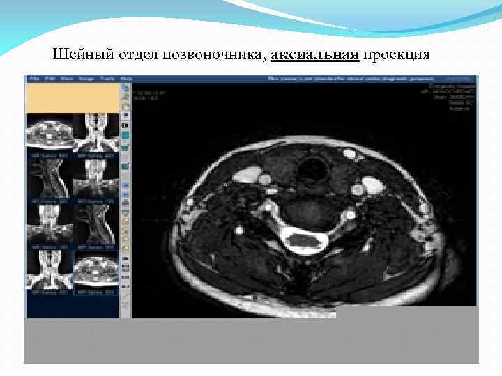 Шейный отдел позвоночника, аксиальная проекция 