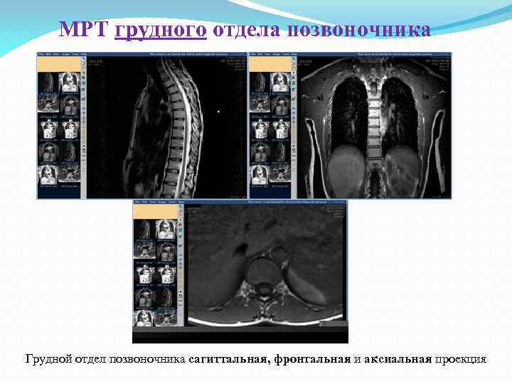 МРТ грудного отдела позвоночника Грудной отдел позвоночника сагиттальная, фронтальная и аксиальная проекция 