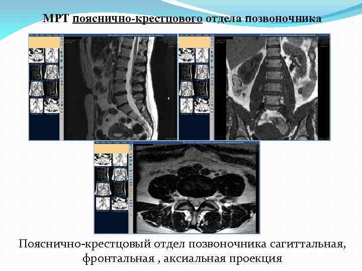 МРТ пояснично-крестцового отдела позвоночника Пояснично-крестцовый отдел позвоночника сагиттальная, фронтальная , аксиальная проекция 
